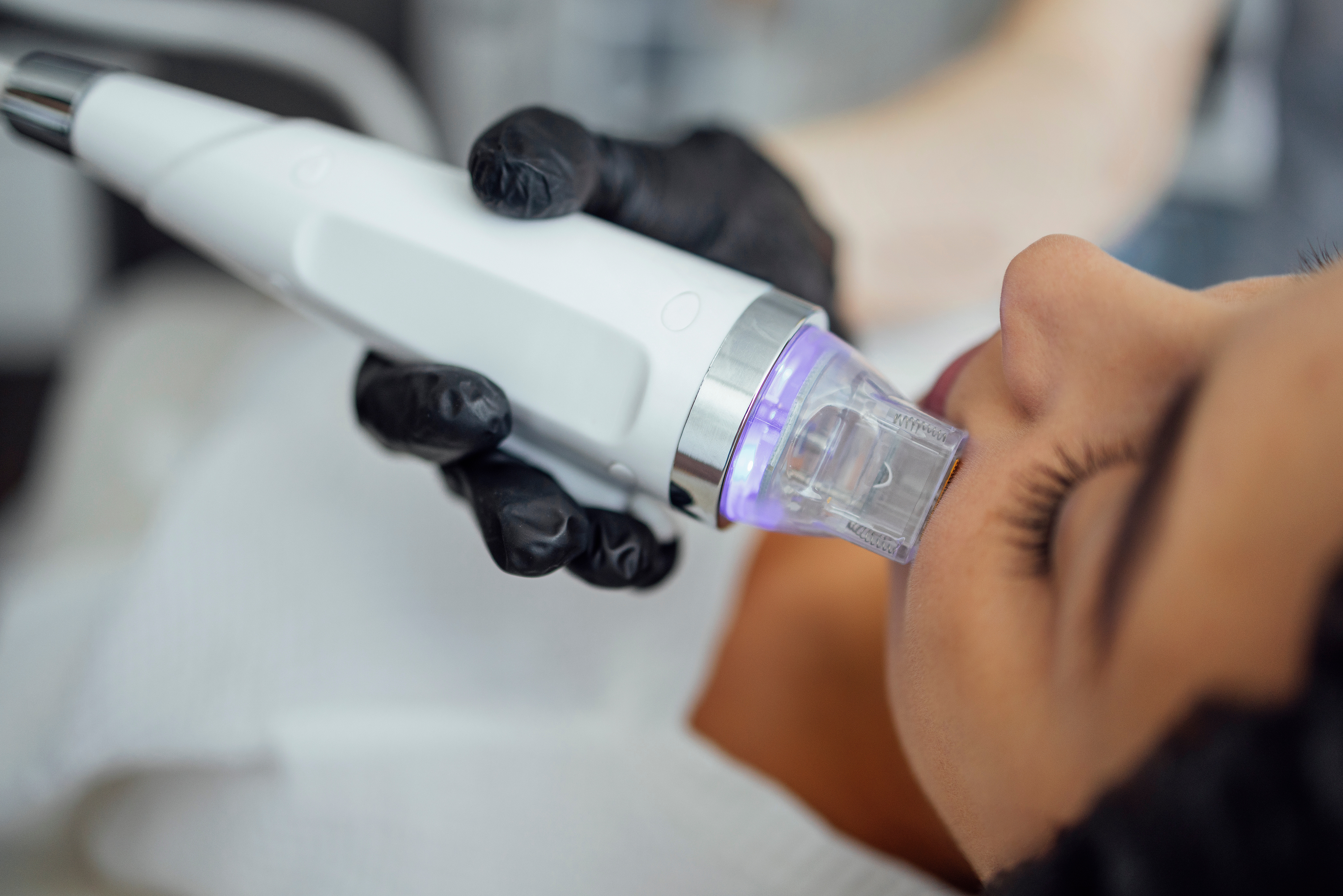 Microneedle RF lifting procedure. Hardware cosmetology. Beautician conducts a facial rejuvenation procedure for a brunette woman